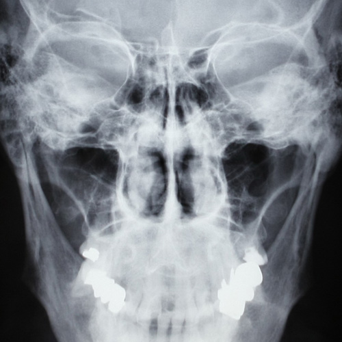 Radiografía de Senos paranasales (1 proyección) en Barcelona