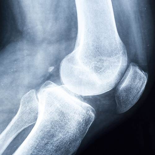 Radiografía de rodilla en Barcelona  AMEDICS Centre Mèdic  al precio de 16€